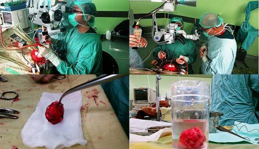 Microneuro surgery tumor removal.jpg